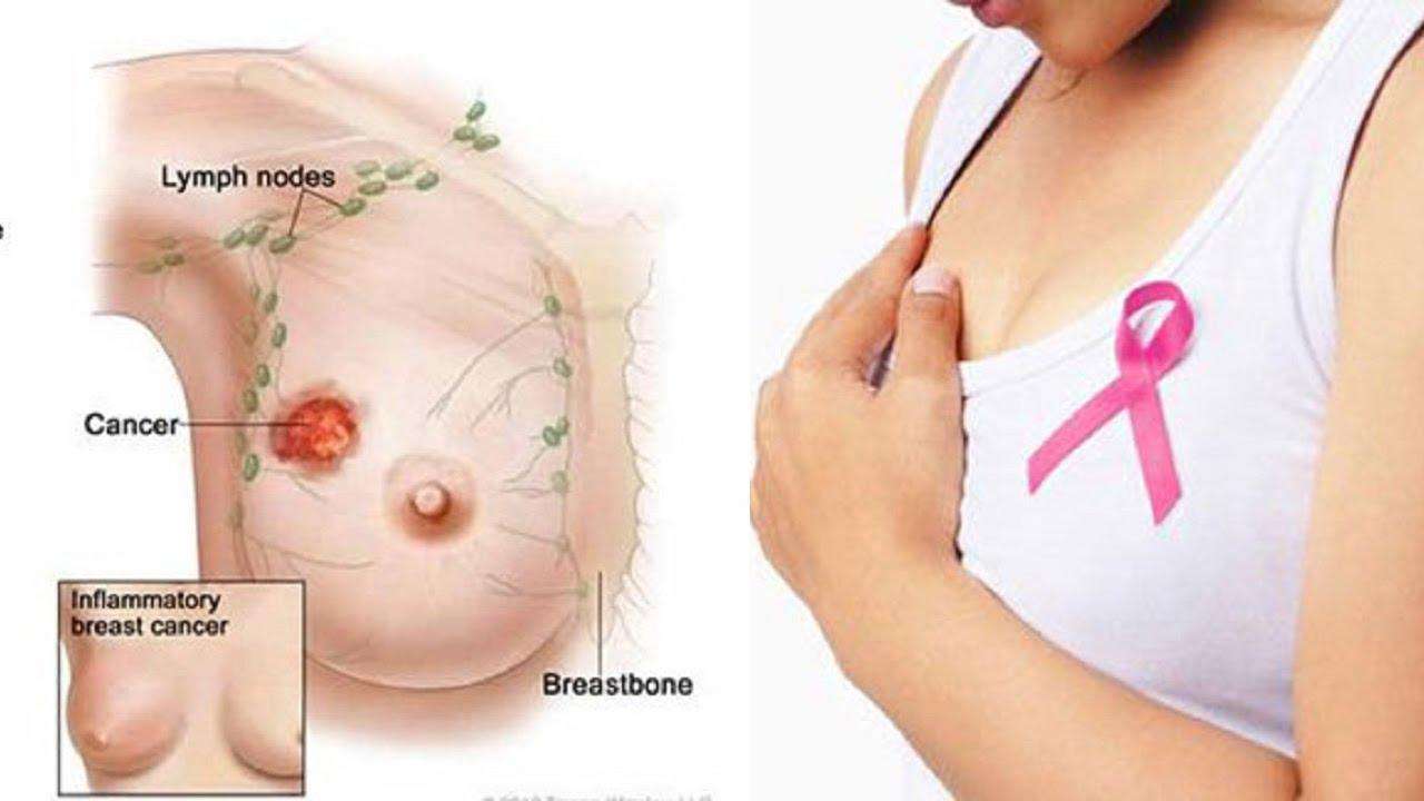 Tìm hiểu về căn bệnh ung thư vú phụ nữ